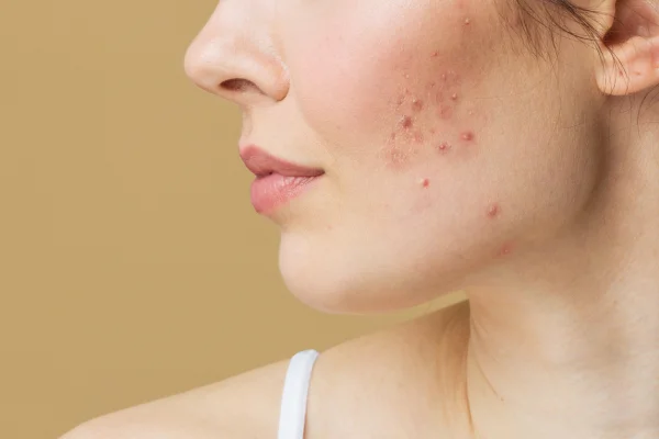 Come eliminare brufoli e punti neri: i nostri consigli per una skincare anti-imperfezioni