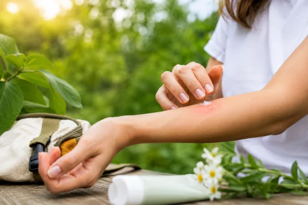 Le migliori creme e pomate per le punture di insetto: guida alla scelta