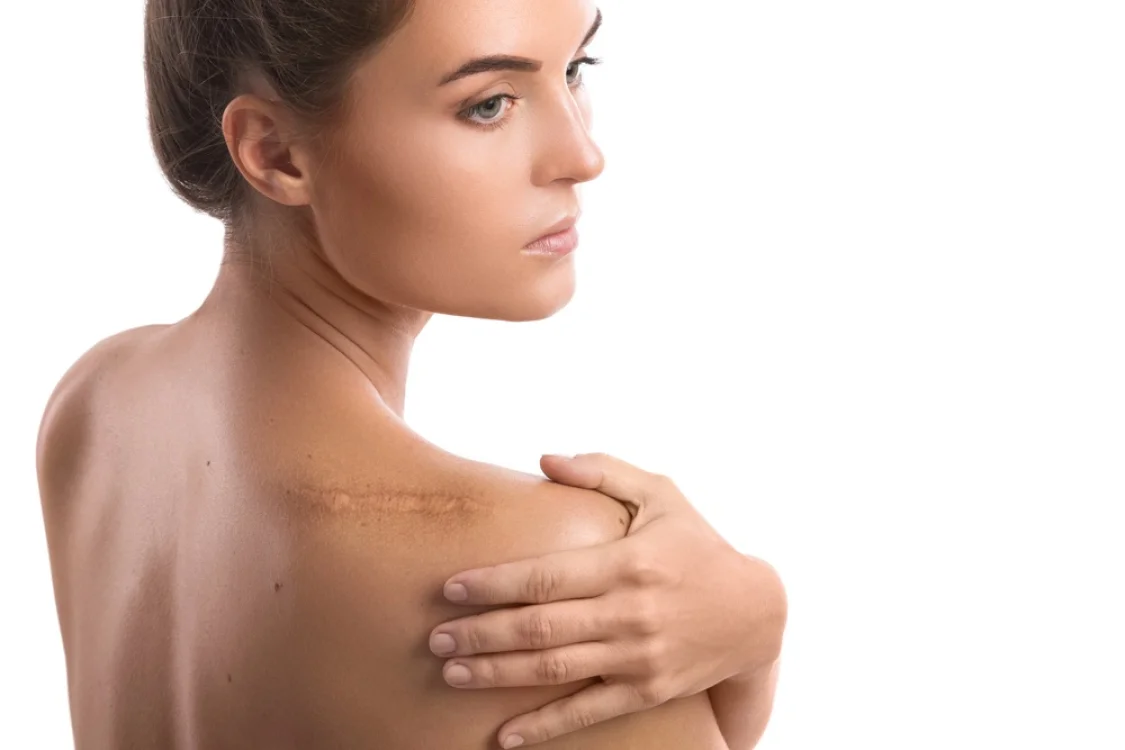 Per saperne di pi&ugrave; sulla cura delle cicatrici