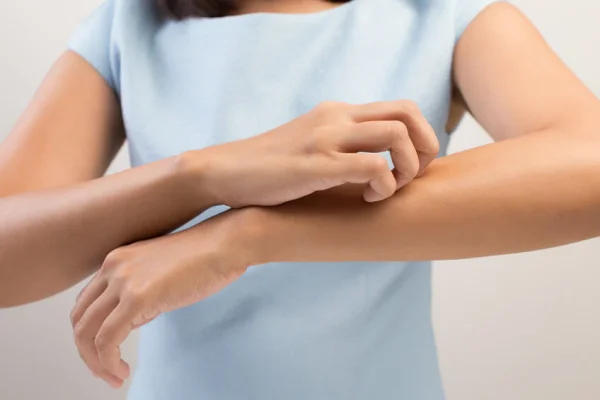 Come prevenire e trattare le punture di zanzare