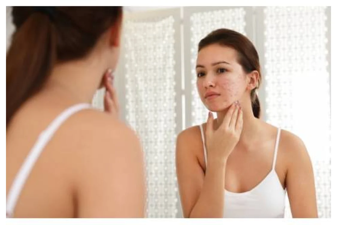 Come trattare le cicatrici da acne